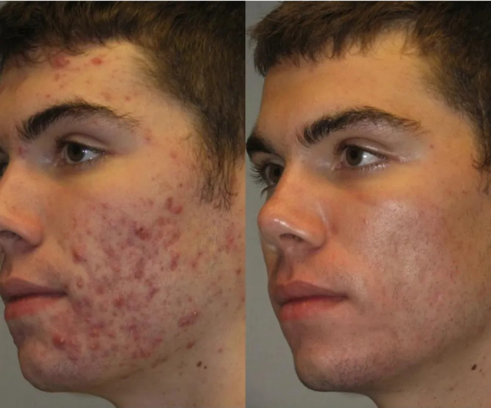 Acné sévère chez l’homme : comment Sébastien a transformé sa peau en 4 semaines grâce à la luminothérapie LED
